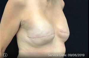 Breast Reduction