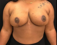 Breast Reduction