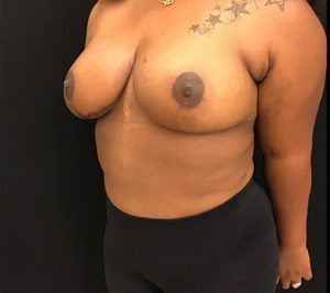 Breast Reduction