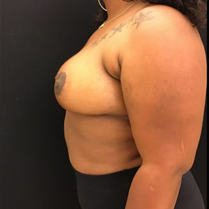 Breast Reduction