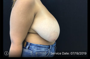 Breast Reduction