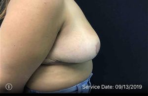 Breast Reduction