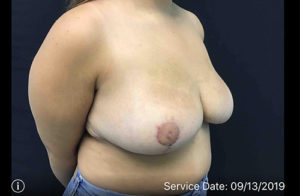 Breast Reduction