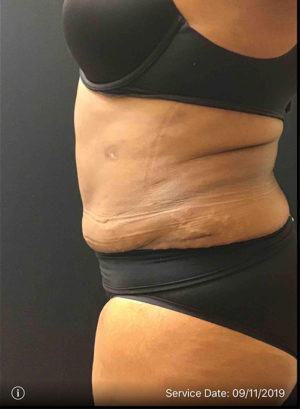 Liposuction