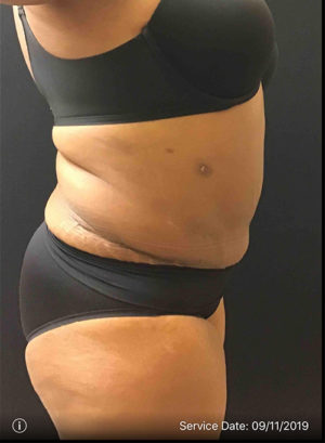 Liposuction