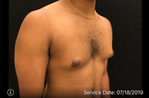 Gynecomastia