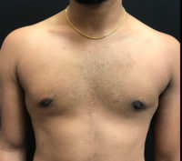 Gynecomastia