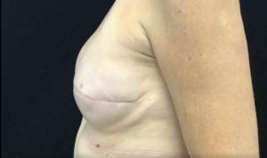 Breast Reconstruction