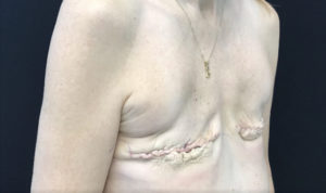 Breast Reconstruction