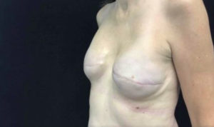 Breast Reconstruction