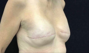 Breast Reconstruction