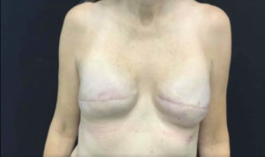 Breast Reconstruction