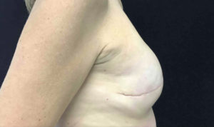 Breast Reconstruction