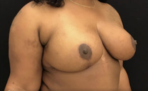 Breast Reduction