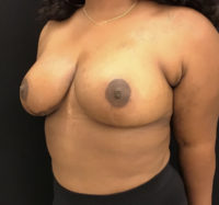 Breast Reduction