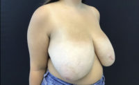 Breast Reduction