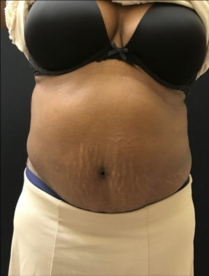 Liposuction