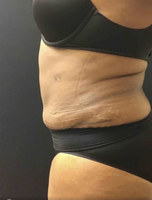 Liposuction