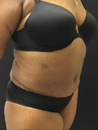 Liposuction