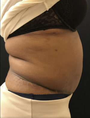 Liposuction