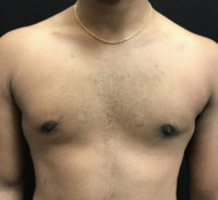 Gynecomastia