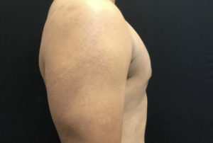 Gynecomastia