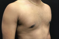 Gynecomastia