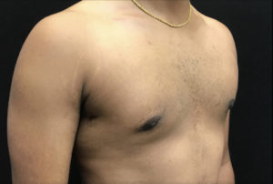 Gynecomastia