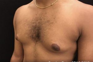 Gynecomastia