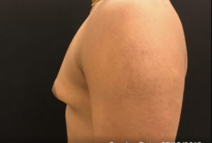 Gynecomastia