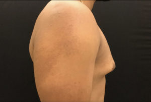 Gynecomastia