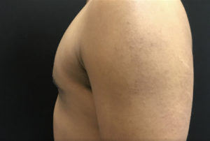 Gynecomastia