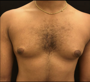 Gynecomastia