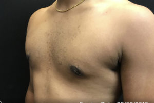 Gynecomastia