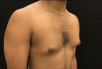 Gynecomastia