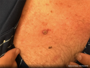 Basal Cell Carcinoma