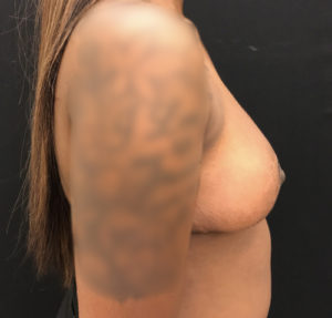 Breast Reduction