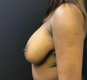 Breast Reduction