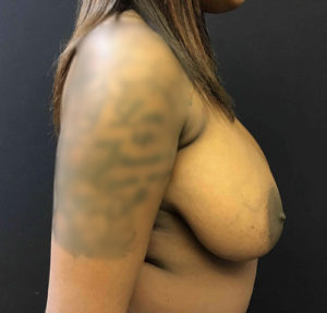 Breast Reduction