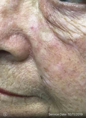 Basal Cell Carcinoma