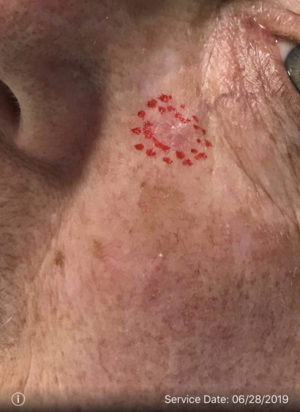 Basal Cell Carcinoma