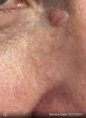 Basal Cell Carcinoma