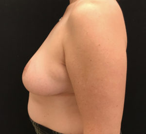 Breast Reduction