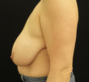 Breast Reduction