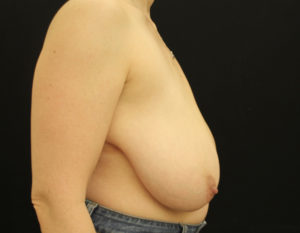 Breast Reduction