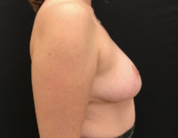 Breast Reduction