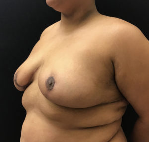 Breast Reduction