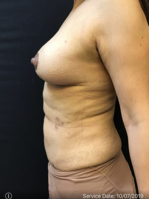 Fat Grafting to Breast