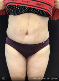 Tummy Tuck