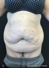 Tummy Tuck